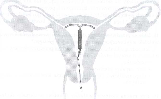 Spirala Antykoncepcyjna